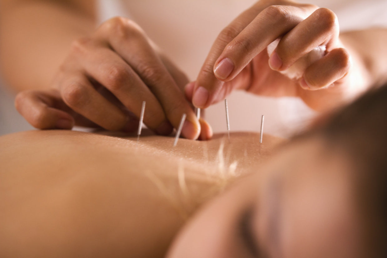 Woman having an acupuncture session